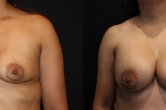 Breast Augmentation - Case 1