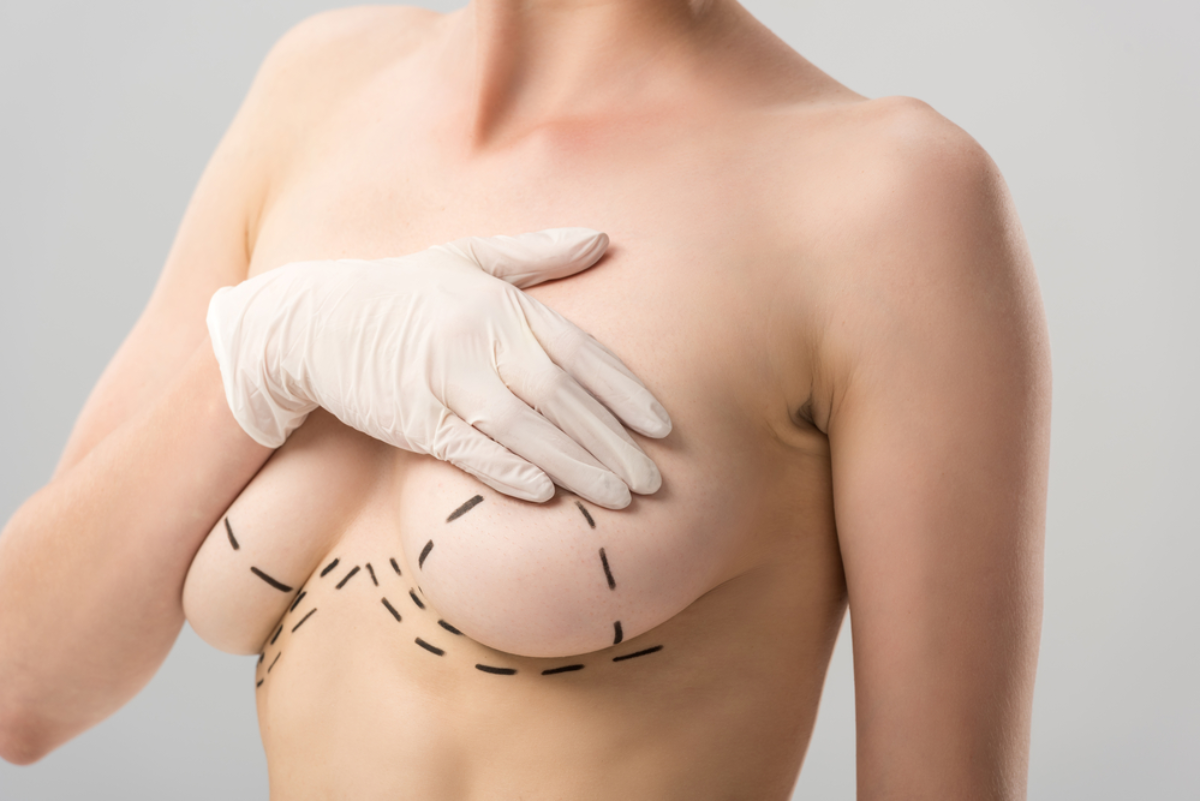 Combined Breast UpLift & Breast Enlargement Surgery (Augmentation