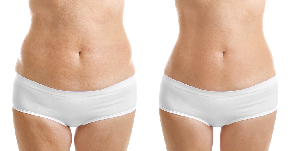 What Areas of the Body Are Best Treated with Liposuction? Chico CA -  Northstate Plastic Surgery Associates