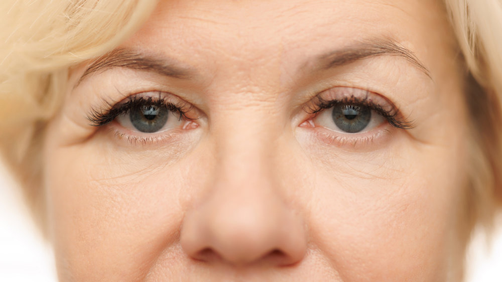 Brow Lift